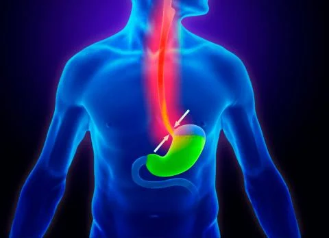 Enfermedades Esofágicas y Gástricas